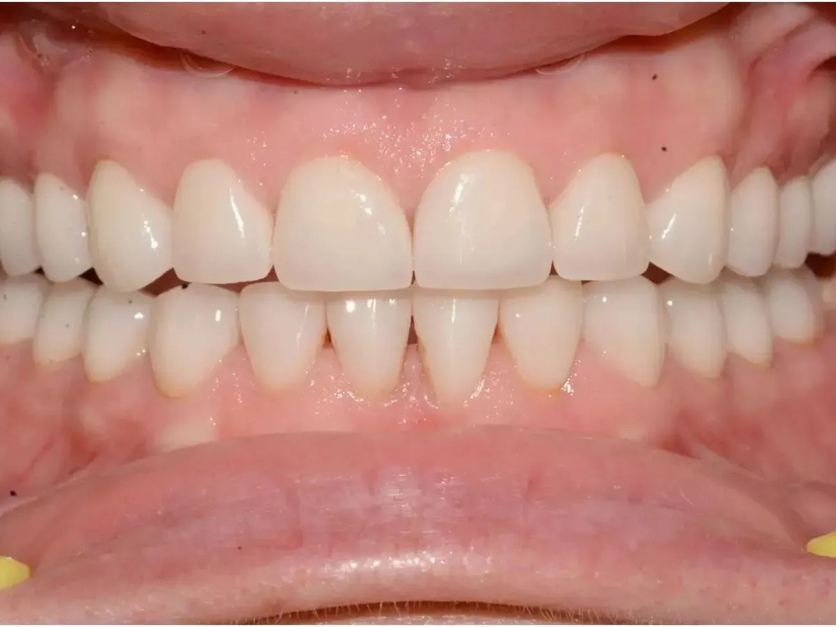 Detaliu cu fațete ceramice finalizate, dinți albi cu aspect natural, DentaSpa Fălticeni