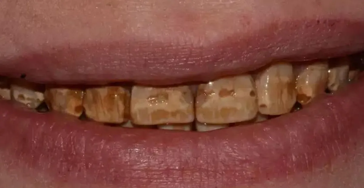 Zâmbet cu dinți afectați de discromie severă, înainte de aplicarea fațetelor dentare