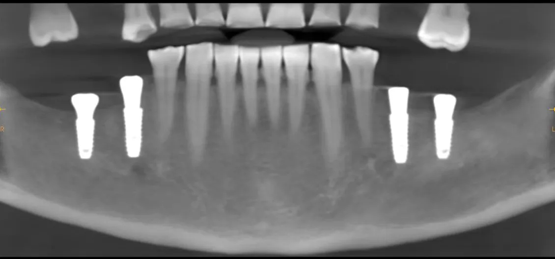 Tomografie CBCT cu implanturile dentare poziționate în osul mandibular