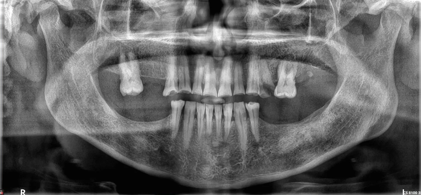 Radiografie panoramică dentară de evaluare, înainte de tratament, la DentaSpa Fălticeni