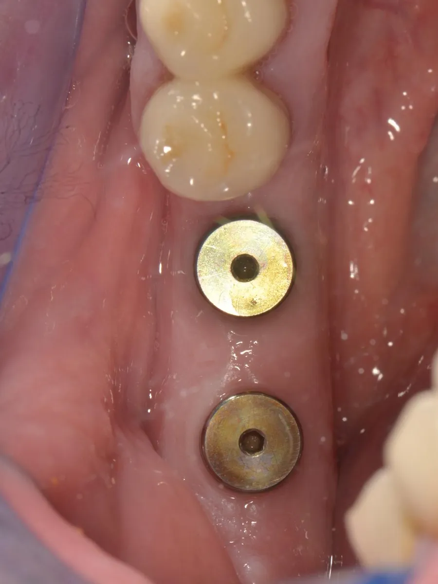 Bonturi de vindecare montate pe implanturi dentare, pentru modelarea gingiei