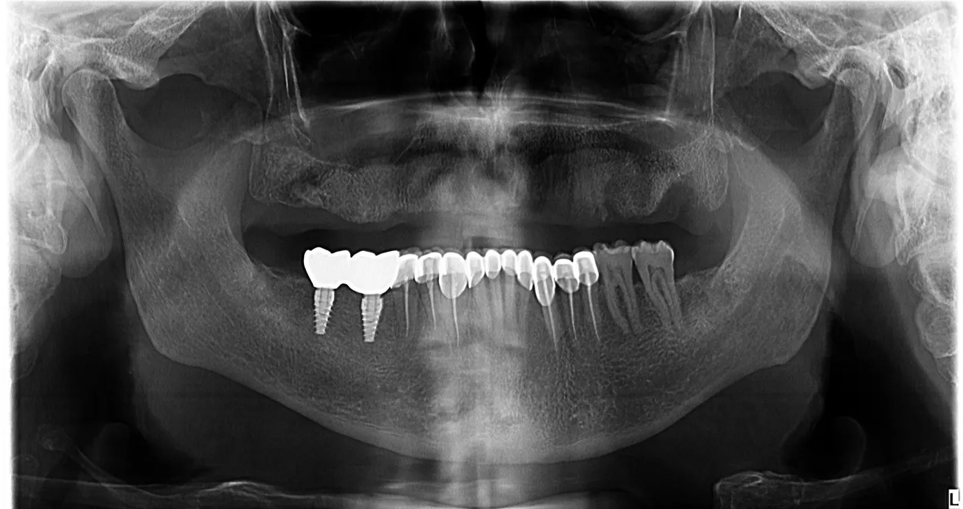 Radiografie panoramică de control după inserarea implanturilor dentare