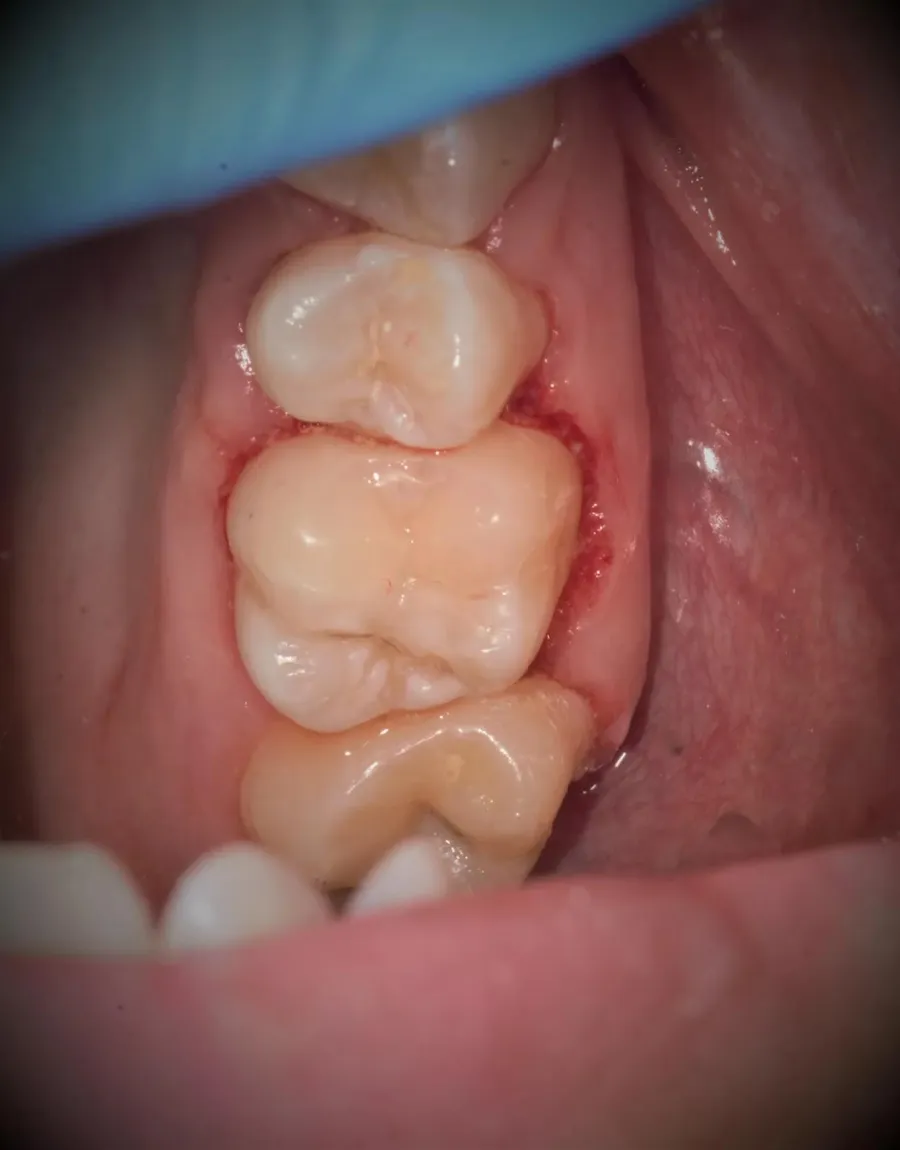 Restaurare estetică sub microscop în Fălticeni, după: molar refăcut cu obturație compozită
