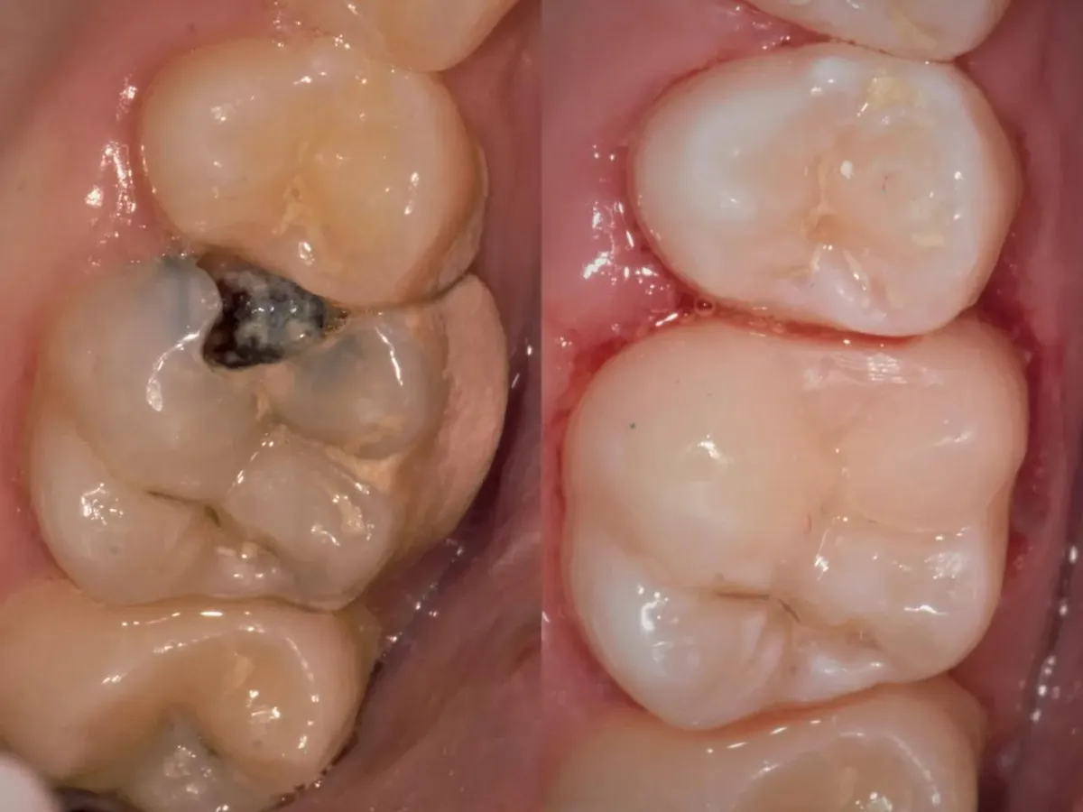 Comparație înainte și după a restaurării unui molar realizate sub microscop dentar