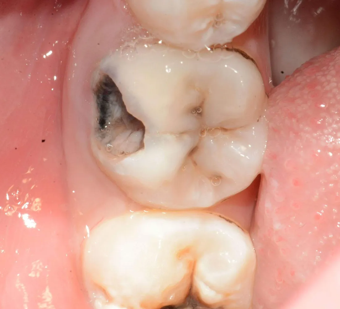 Tratament la microscop în Fălticeni, înainte: molar cu carie extinsă