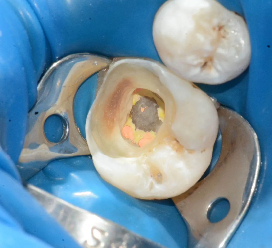 Molar izolat cu digă în timpul tratamentului efectuat sub microscop dentar